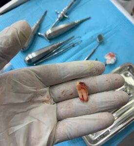 a hand in a glove holding a tooth