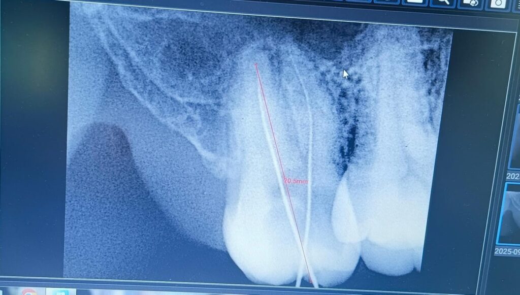 a x-ray of teeth